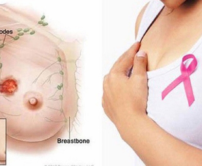 Béo phì và nguy cơ ung thư vú